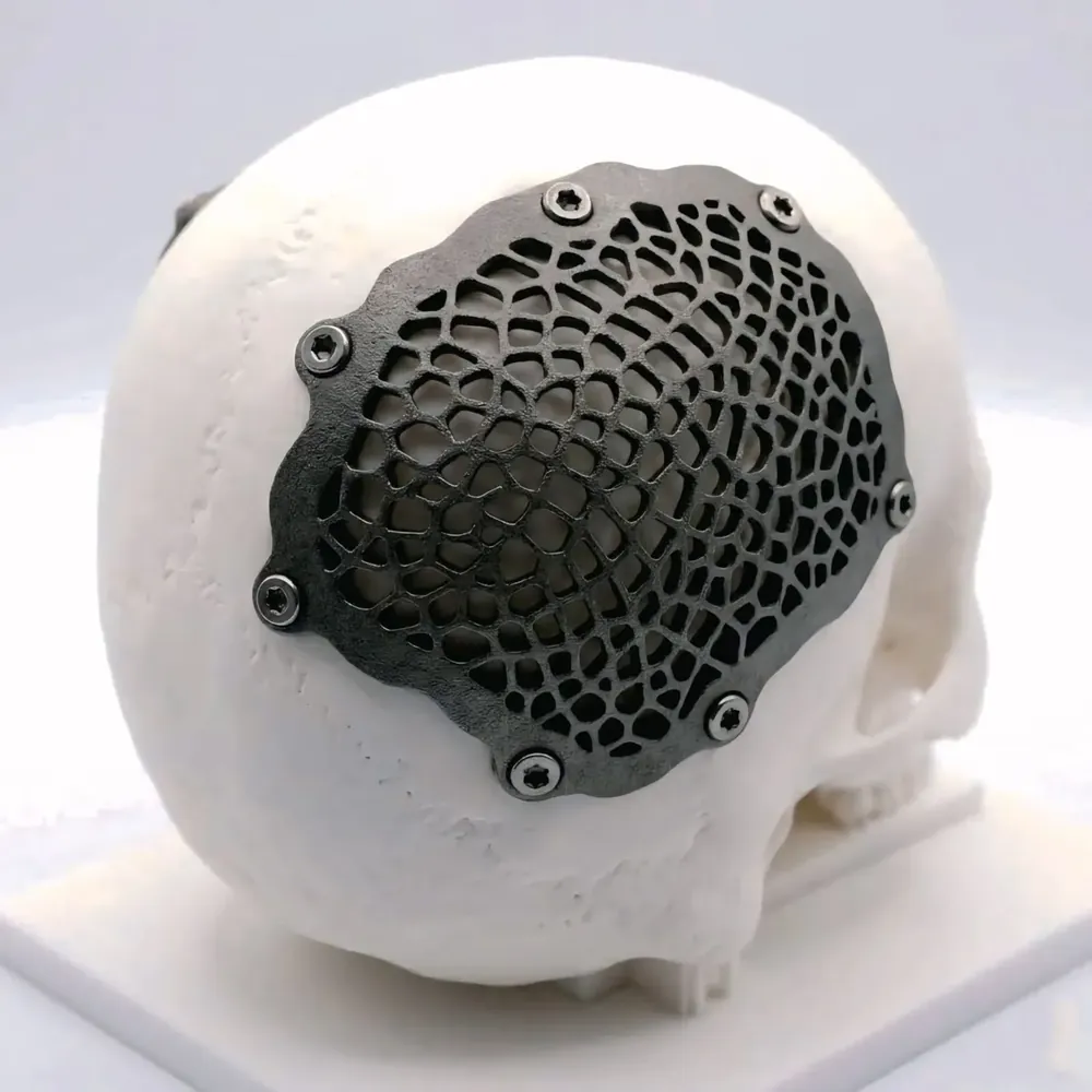 Cranial implant